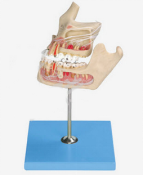 KAY-A532牙体病变模型-牙齿病变系列模型-牙体病理模型-上海康谊医学教学仪器设备有限公司